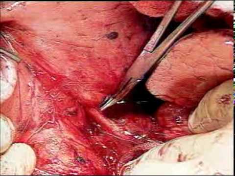 Lung Cancer Surgery Video Lobectomy Hqdefault