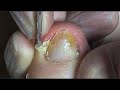 Jagged nail inside toe