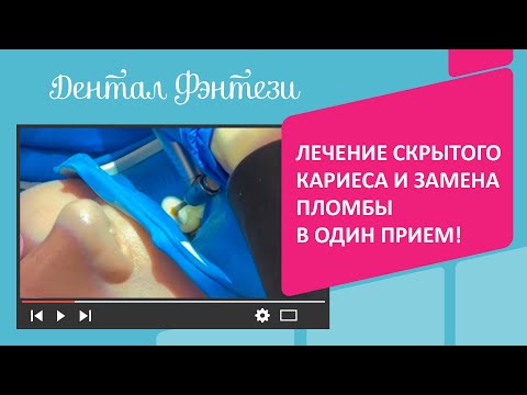 Лечение Скрытого Кариеса И Замена Пломбы В Один Прием!