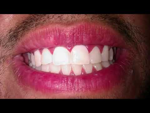 Video: Kaviteti I Qelbës Që Formohet Nën Dhëmbë Në Qen