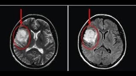Brain Tumor Detection using Matlab - Image Processing + GUI step by step