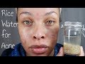 RICE WATER FOR ACNE & DARK CIRCLES - BEFORE & AFTERS