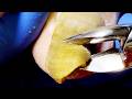 Extremely Long Onychomycosis, Slowly Cut It Off【Xue Yidao】