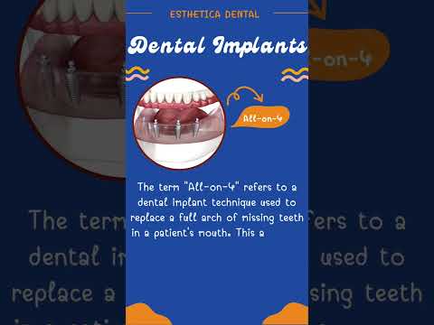 All-on-4 Dental Implants: Transform Your Smile with Confidence