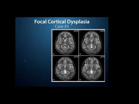 ESTM webinar series: Global Epilepsy Surgery Technique Rounds