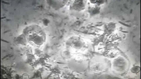 disease caused by spirochetes.MOV