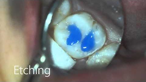 Class I Composite Advanced Microscope Dentistry Club