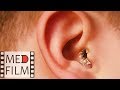 Гноетечение из уха . Нистагм. Отит © Suppuration of the ear. Nystagmus. Otitis