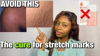 NO MORE STRETCH MARKS | How to treat stretch marks | Does Bio Oil work ?