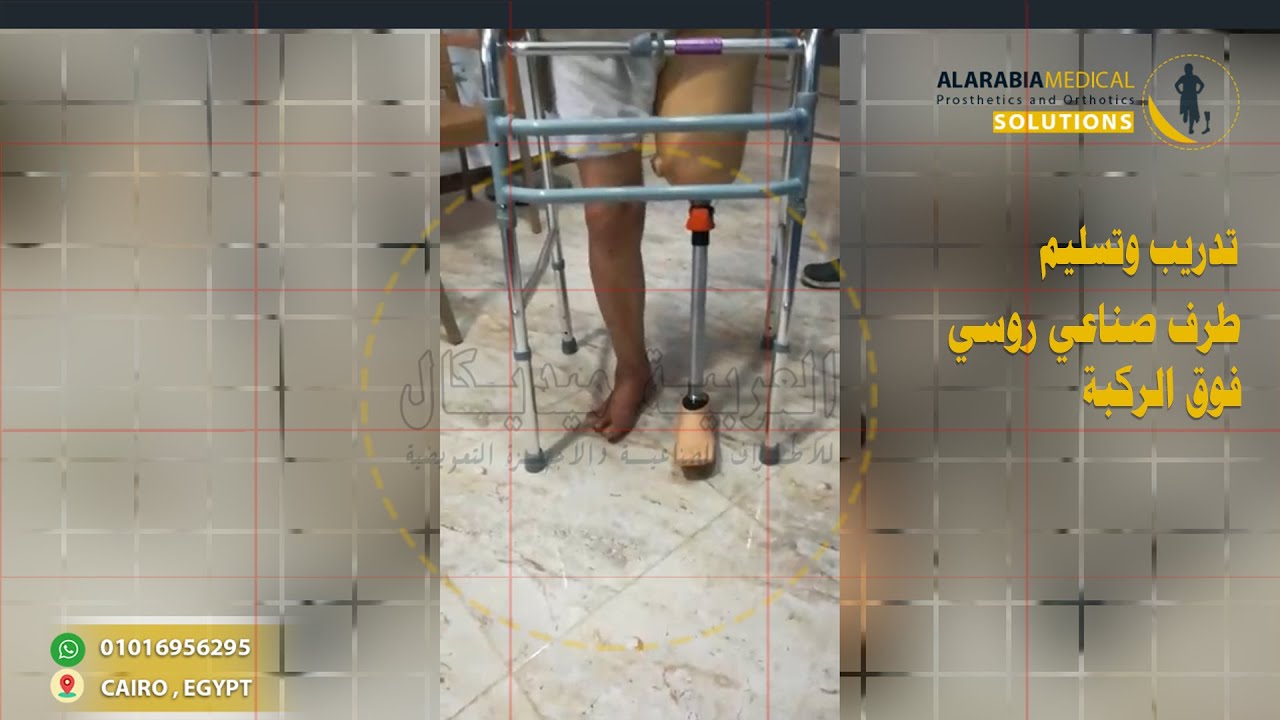 طرف صناعي روسي فوق الركبة  بقدم متحرك | Above Knee Prosthetic