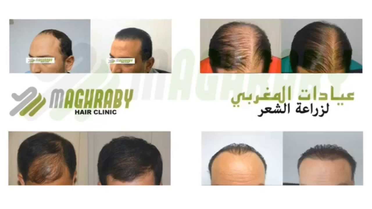 Agriculture Blog زراعة الشعر في مصر Fue