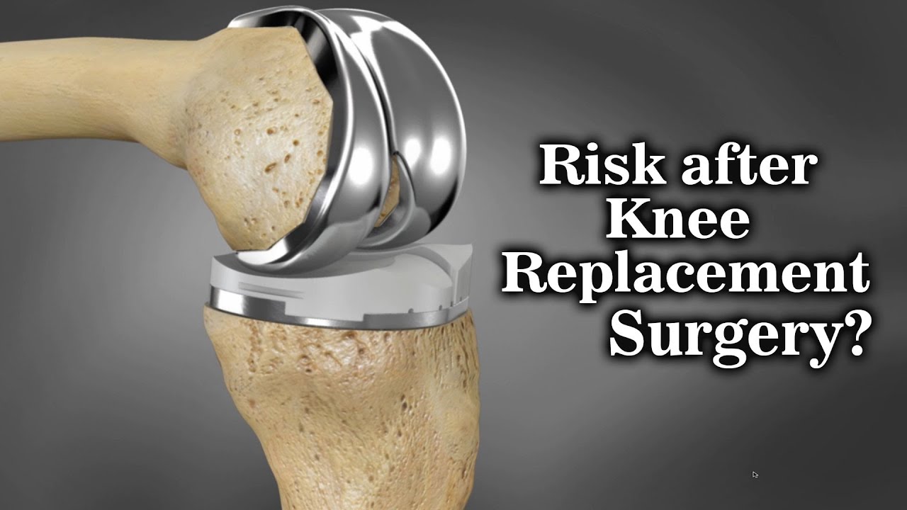 Risk after Knee Replacement Surgery? Dr. Pushpendra Bajaj