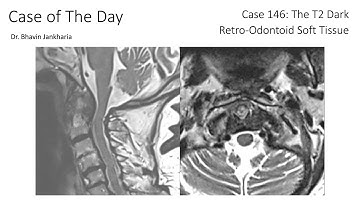 Case of the Day - 146 - The T2 Dark Retro Odontoid Soft Tissue
