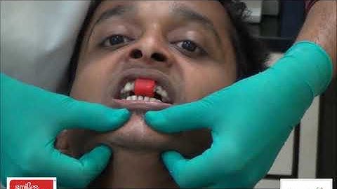 Centric Relation Record with Lucia Jig