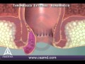 Thrombosed external hemorrhoid  3d medical animation