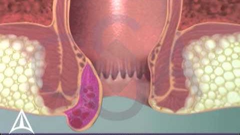 Thrombosed External Hemorrhoid - 3D Medical Animation