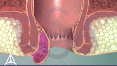 Thrombosed External Hemorrhoid - 3D Medical Animation - DayDayNews