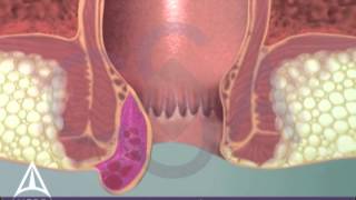 Thrombosed External Hemorrhoid - 3D Medical Animation screenshot 2