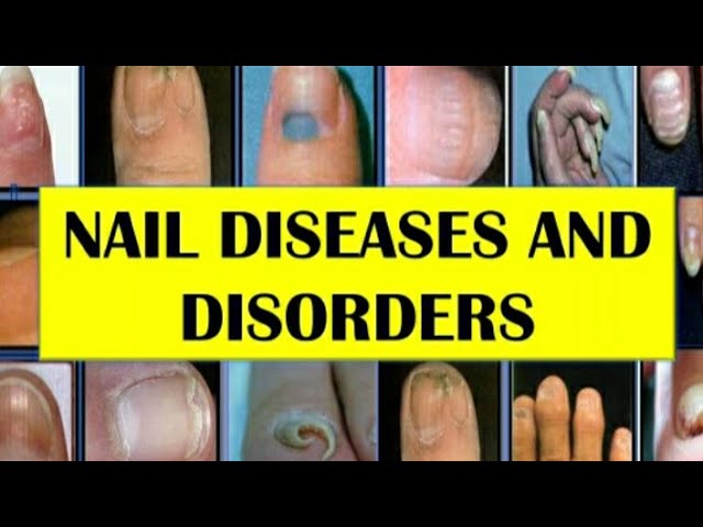 Structure of Nails And Nail Disorders