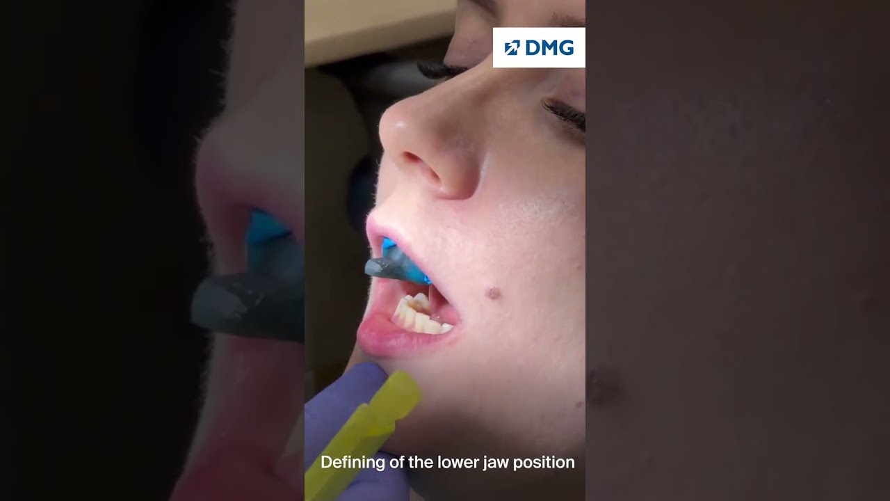 Use the 3D printed LuxaPrint Tray in your dental practice to optimally capture the bite position