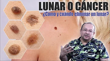 ¿Es seguro extirpar un lunar canceroso?