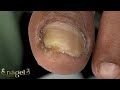 Uma unha que exigiu muito cuidado e técnica... veja o antes e depois #satisfying #nails