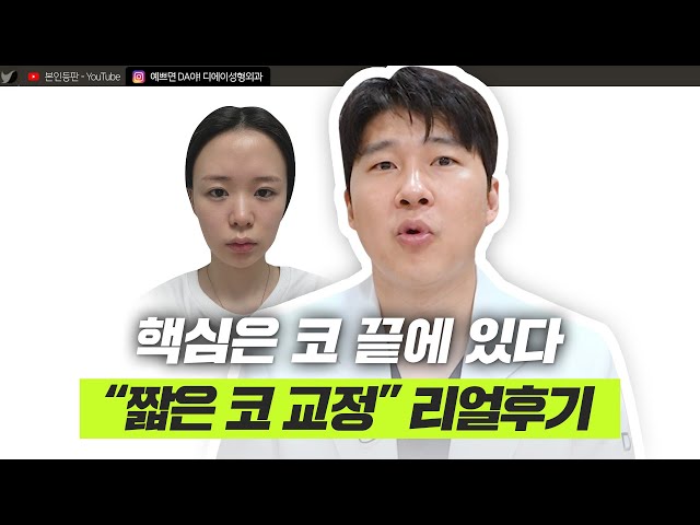 짧은 코 교정, 실제 케이스로 확인해보세요! ㅣ디에이성형외과