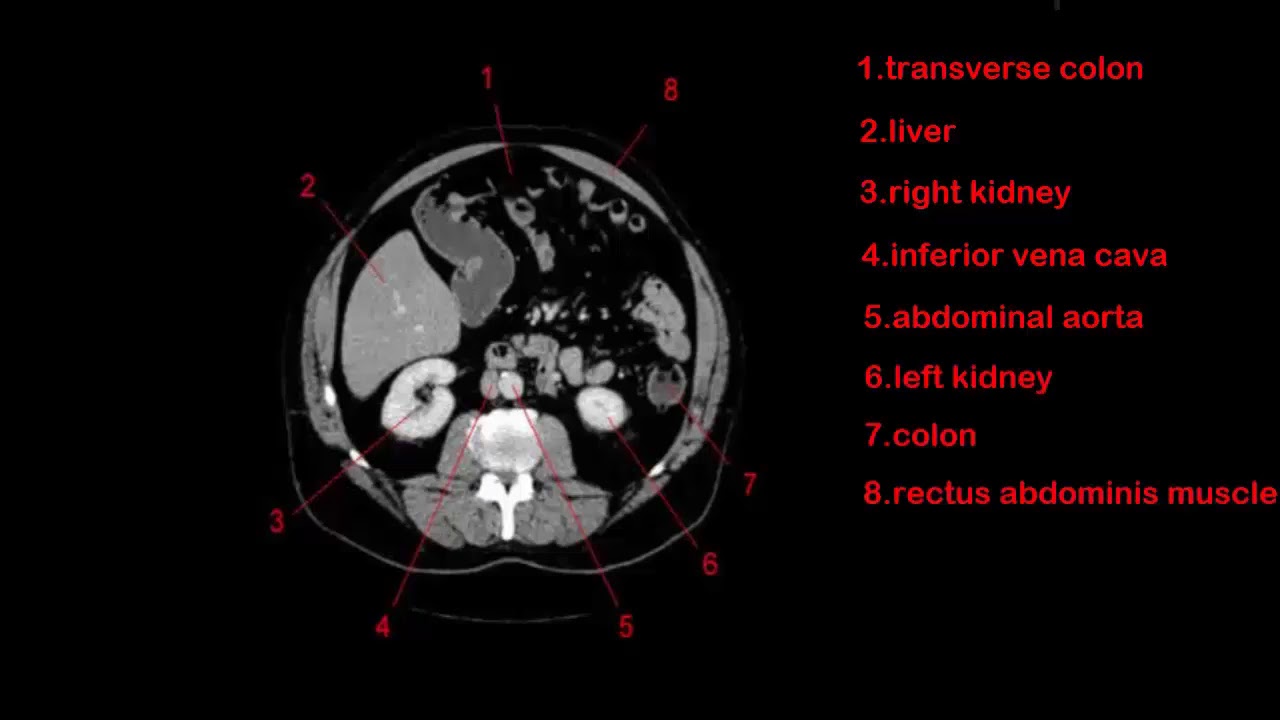How To Read Ct Abdomen Axial Images YouTube How To Read Ct Abdomen Axial Images YouTube