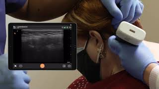 Scanning Technique: Occipital Nerve Block