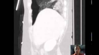Chest CT S-P MVC Discussed by Radiologist.mp4