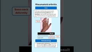 Rheumatoid arthritis for med students #medicaleducation #rheumatology