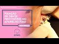 Fixação de dente provisório em aparelho fixo - Técnica