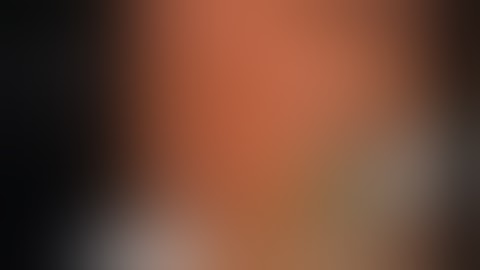 ERCP: CBD stone extraction