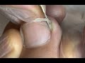Hard fingernails pressing on the edges of the toes