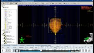 SBRT for Prostate Cancer for Eclipse User