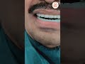 Full Mouth Dental Implants At @EledentDentalHospitals | Best Dental Hospital In India #ytshorts