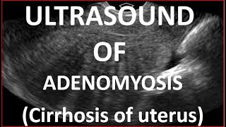 Ultrasound of Adenomyosis