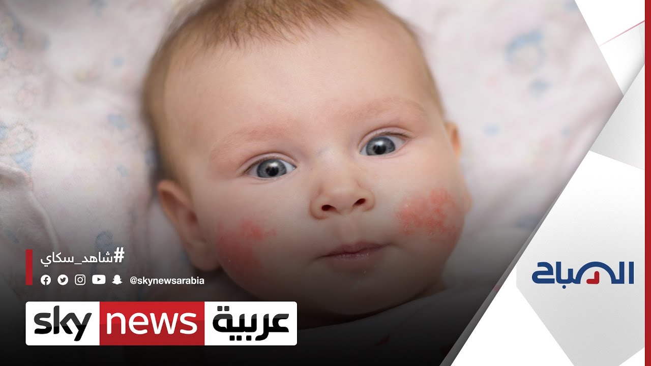 ما هو التهاب الجلد التأتُّبي عند الأطفال أو الإكزيما؟ وكيف يمكن علاجه؟ | #الصباح