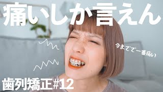 【歯列矯正】１年2ヶ月！矯正史上最大の痛みに泣いた。【抜歯表側ワイヤー矯正】