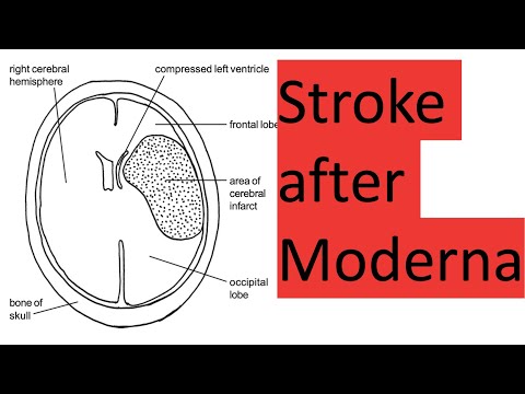 Stroke and death after Moderna