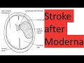 Stroke and death after Moderna