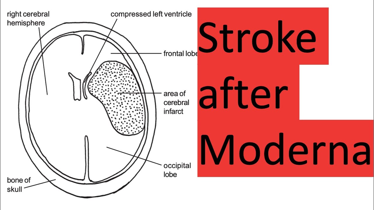 Stroke and Worse after the Moderna Jab