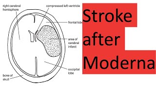 Stroke and worse after Moderna