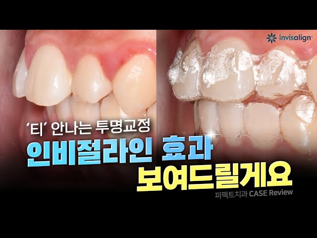 강남역치과 투명교정 인비절라인 효과 없다고❓ 돌출입교정 결과는..?!