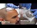 Final wash ka tariqa  how to final wash after hair transplant