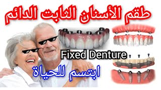 طقم الأسنان الثابت الدائم بأنواعه و مميزاته و عيوبه و أسعاره Fixed permanent Dentures