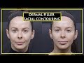 All About Facial Contouring With Dermal Fillers