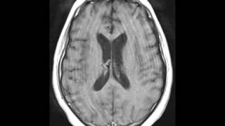 Herpes Encephalitis