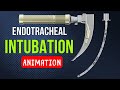 Endotracheal intubation  animation  pediatrics