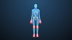 Rheumatoid Arthritis: Treatments for Stiff, Painful Joints